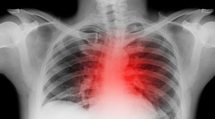 Malattie cardiache, ecco i farmaci che possono aumentare il rischio decesso: la sentenza nello studio