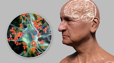 Ictus e Alzheimer, il Covid "uccide" lentamente il nostro cervello: i risultati dello studio-chioc