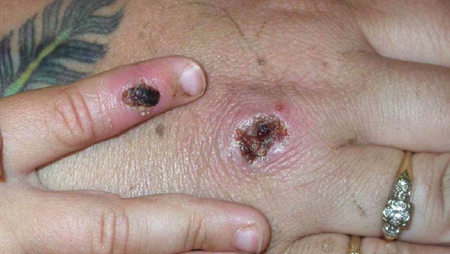 Vaiolo delle scimmie, temete di più il nuovo virus o una nova psicosi? Vaiolo delle scimmie, temete di più il nuovo virus o una nova psicosi?