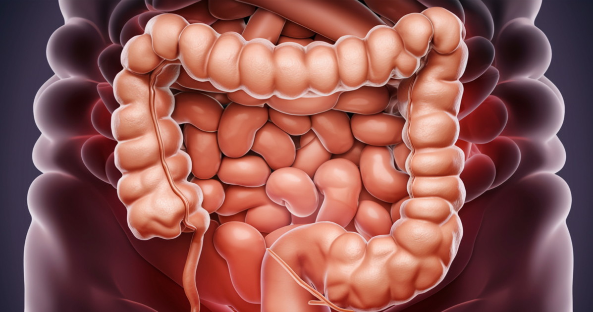 tumore al colon e intestino giovane la ricerca che cambia tutto da Liberoquotidiano.it tumore al colon e intestino giovane la ricerca che cambia tutto